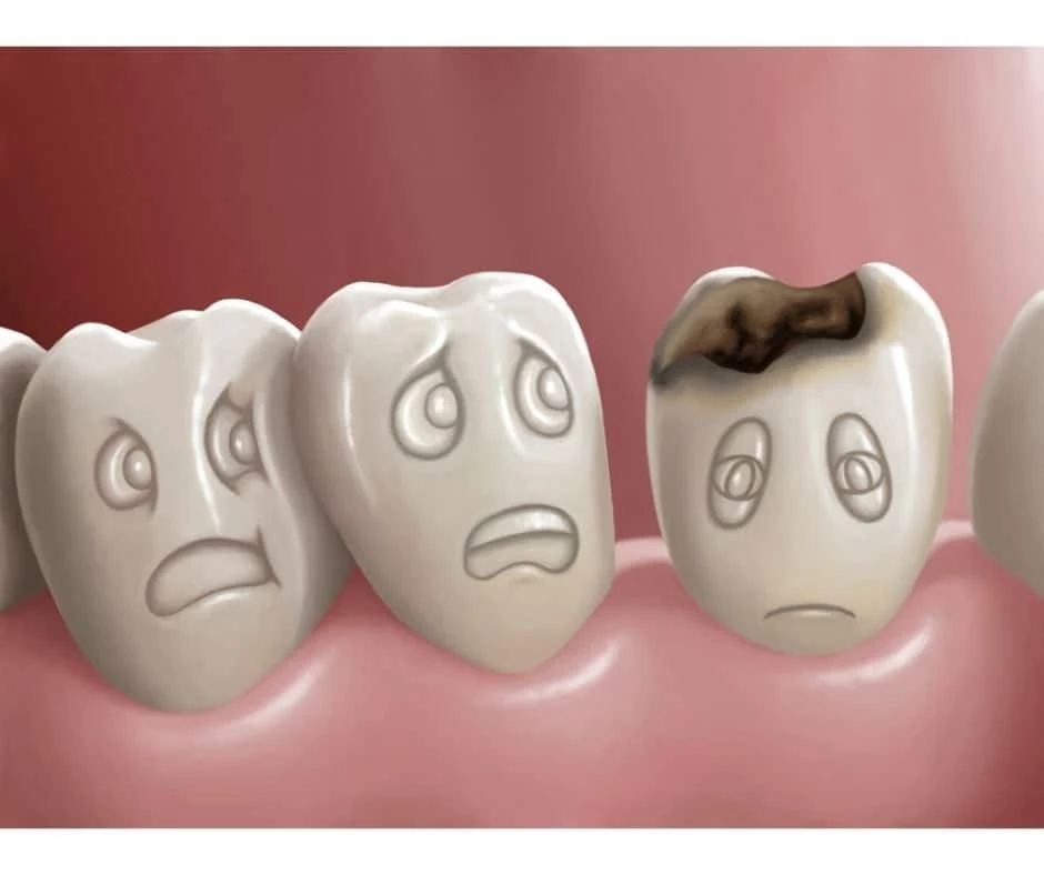 Here Are Some Cavity Stages You Need To Know