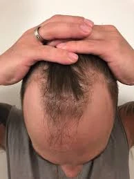 How to Find the Best Hair Transplant Clinic in the UK