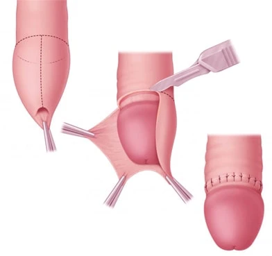 Circumcision Surgery: The Procedure And the Methods Used