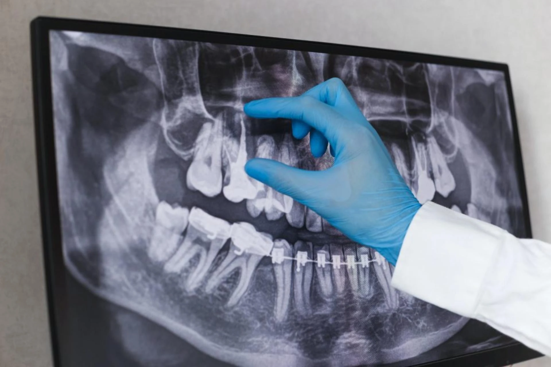4 Tips For Choosing A Dentist For Root Canal Treatment