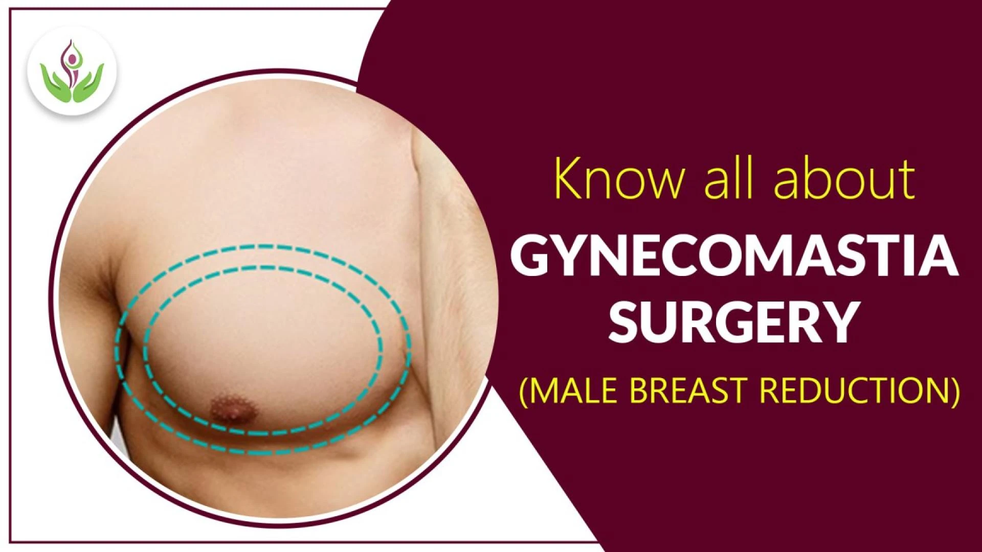 Know all About Gynecomastia Surgery (Male Breast Reduction)
