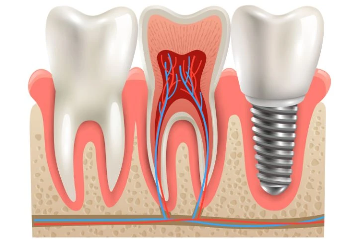 Dental Implants Services: What You Need to Know