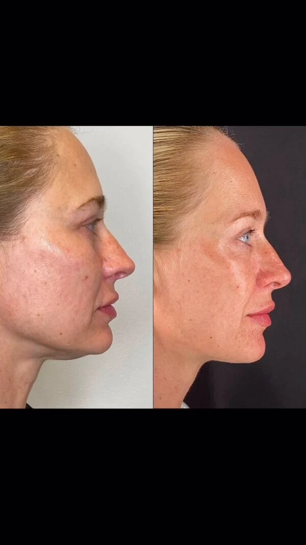 Lip Fillers &amp; Dermal Fillers for a Younger Look | Lifestyle's MedSpa | Warrenton &amp; Culpeper