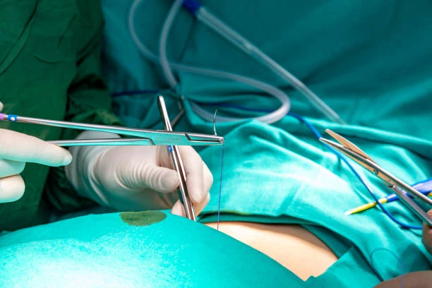 As A Medical Instrument, Surgical Sutures Are Used To Close Open Wounds And Ligate Blood Vessels During Or After Surgical Procedures Like Orthopaedic Surgery