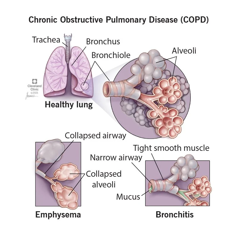 What is Chronic obstructive pulmonary disease (COPD) ?