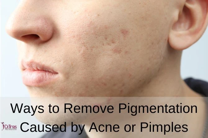 Ways to Remove Pigmentation Caused by Acne or Pimples