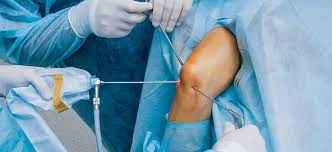 Arthroscopy: What is it? What are its benefits?