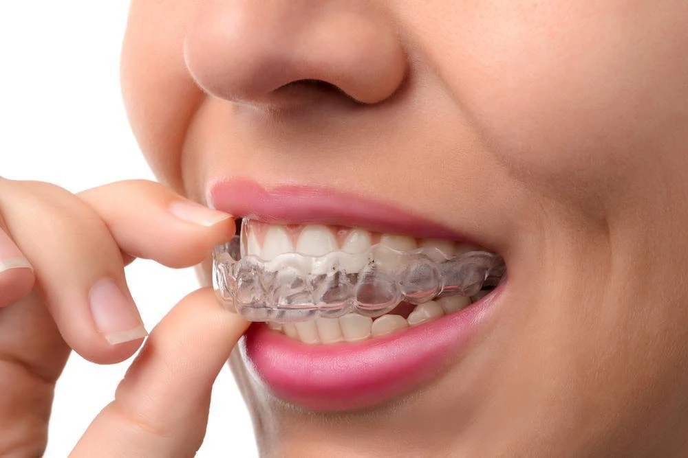 Your Dentist Can Help Determine If You're a Candidate For Invisalign