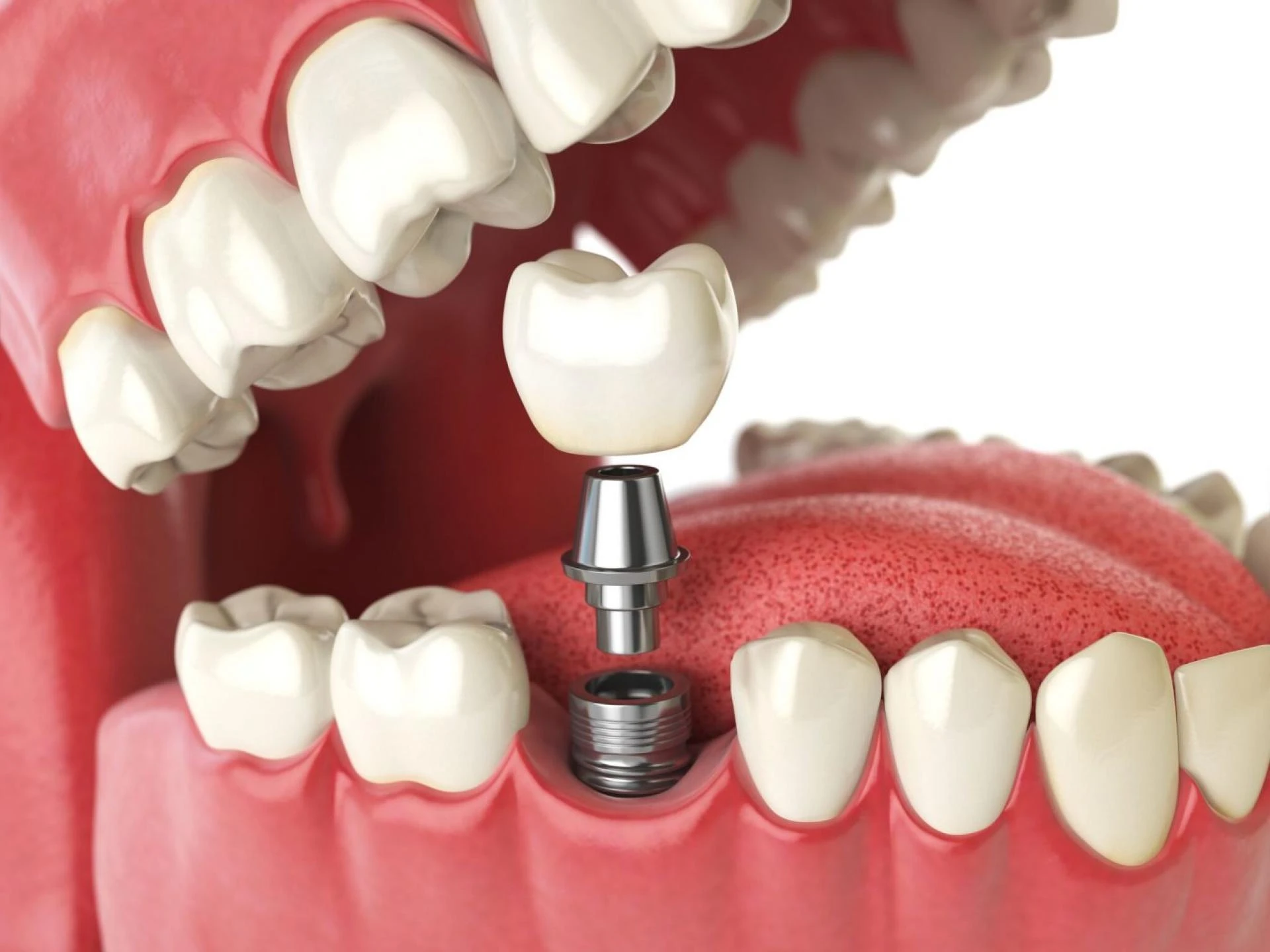 Learn More About the Cost of Dental Implants