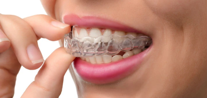 How Long Does It Take To Get Invisalign