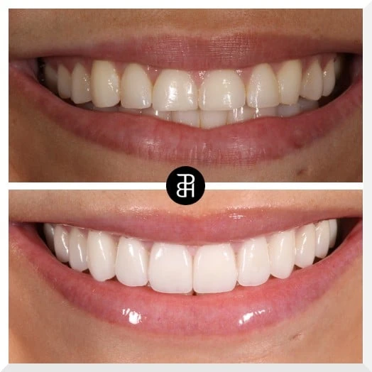 What is Veneers Teeth?