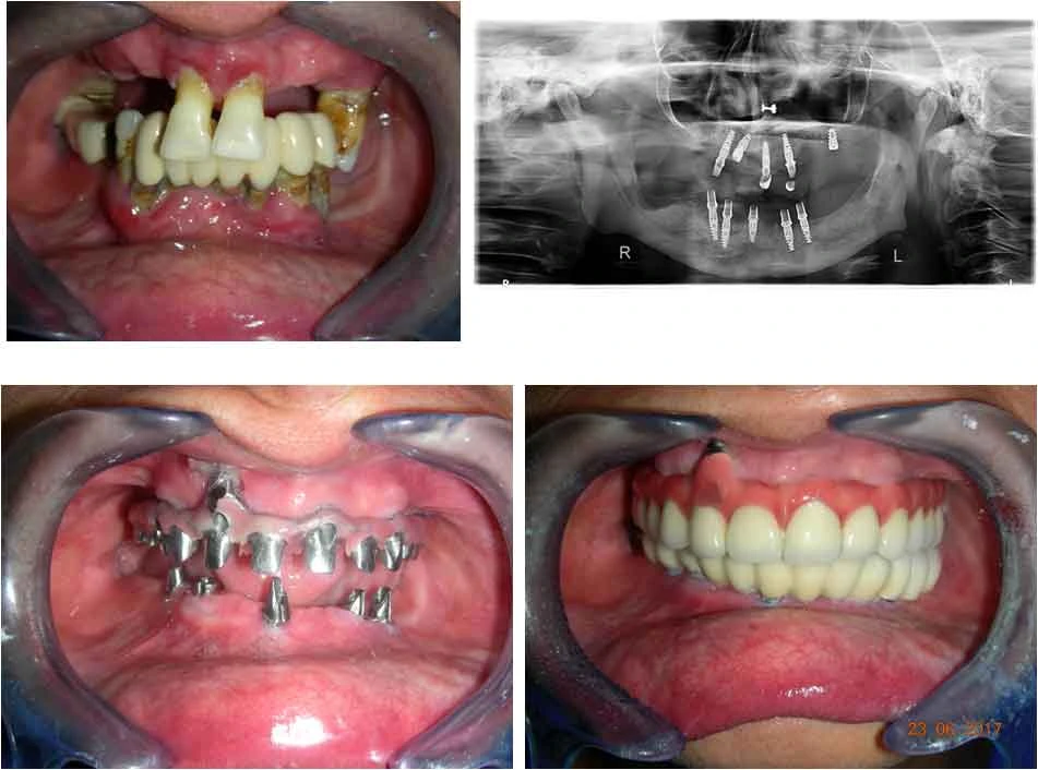 dental implants in Chandigarh, Mohali,India - Chandigharh Ortho...