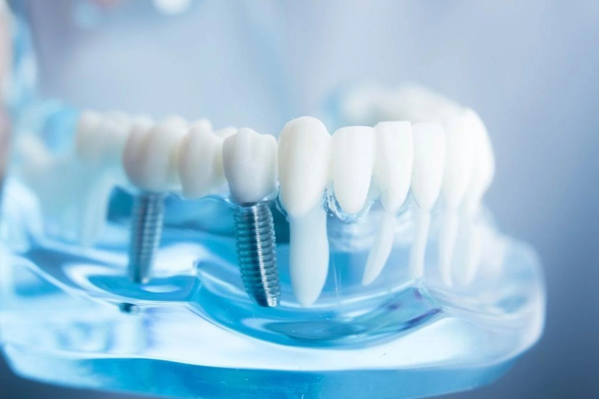 What is dental Implants - Chandigarh orthodontics