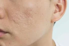 أنواع مختلفة من العلاج لإزالة الندبات