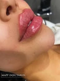 ما هو علاج حشو الشفاه الروسي؟