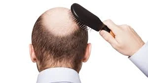 ما هي زراعة الشعر الهجين؟