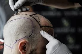 ACell + PRP في جراحة زراعة الشعر