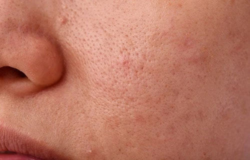 How Can I Prevent Open Pores on the Face?