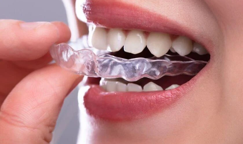 How Does Invisalign Work Its Magic on Misaligned Teeth?