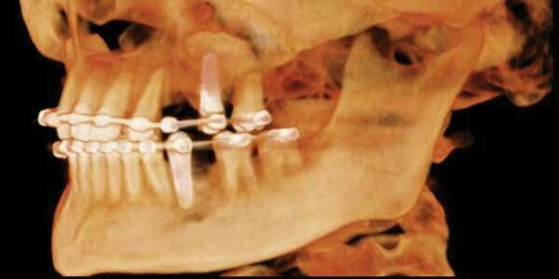 What You Need to Know About the i-CAT FLX CBCT Machine
