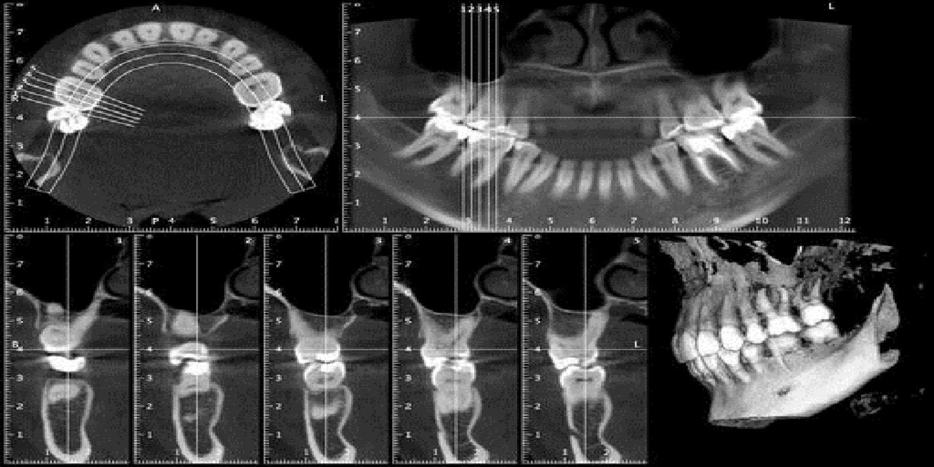 What Makes the Planmeca ProMax 3D So Popular Among Dental Professionals?