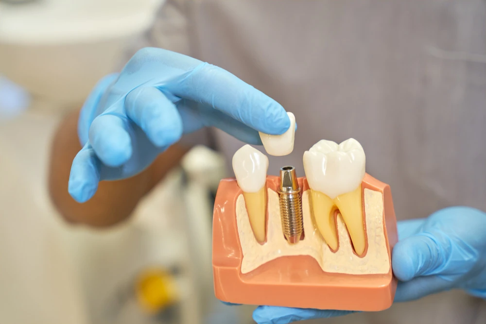 Common Myths About the Dental Implants Procedure