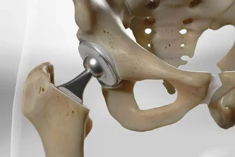 Hip Replacement Surgery Cost