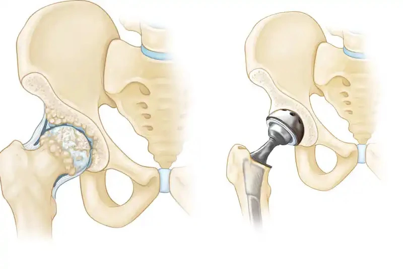 Hip Replacement Surgery in Delhi