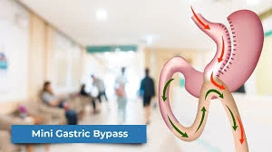 Unlock Your Weight Loss Potential with Mini Gastric Bypass in Dubai