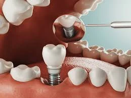 "Transform Your Smile: Dental Implants in Abu Dhabi"