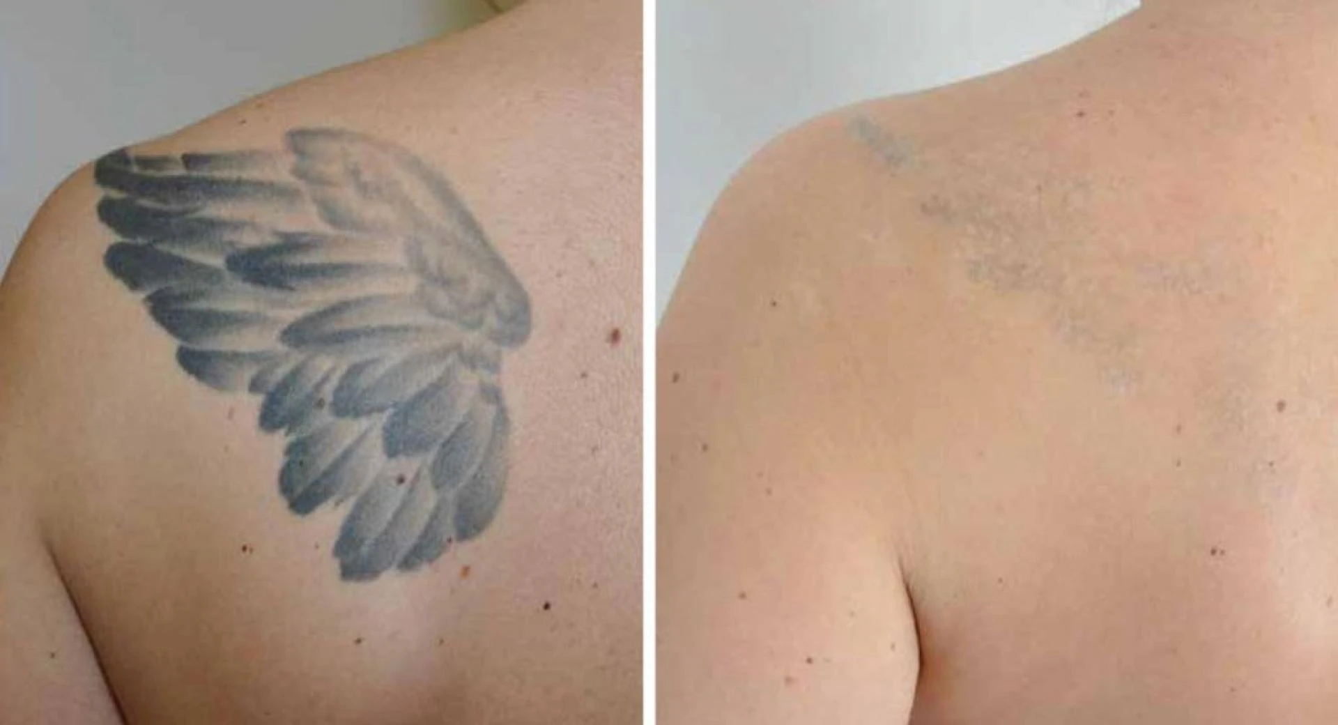"Beyond the Ink: Laser Tattoo Removal Services in Abu Dhabi"