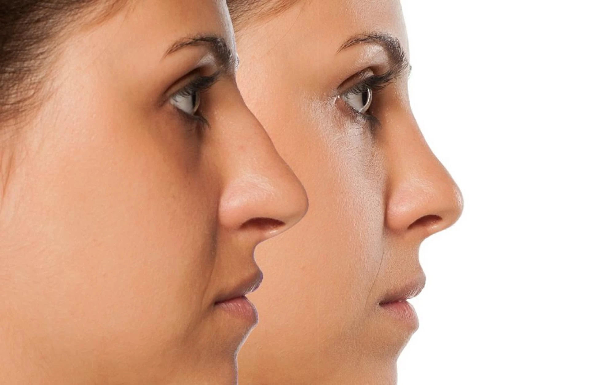 Finding Balance: The Harmony of Rhinoplasty Surgery