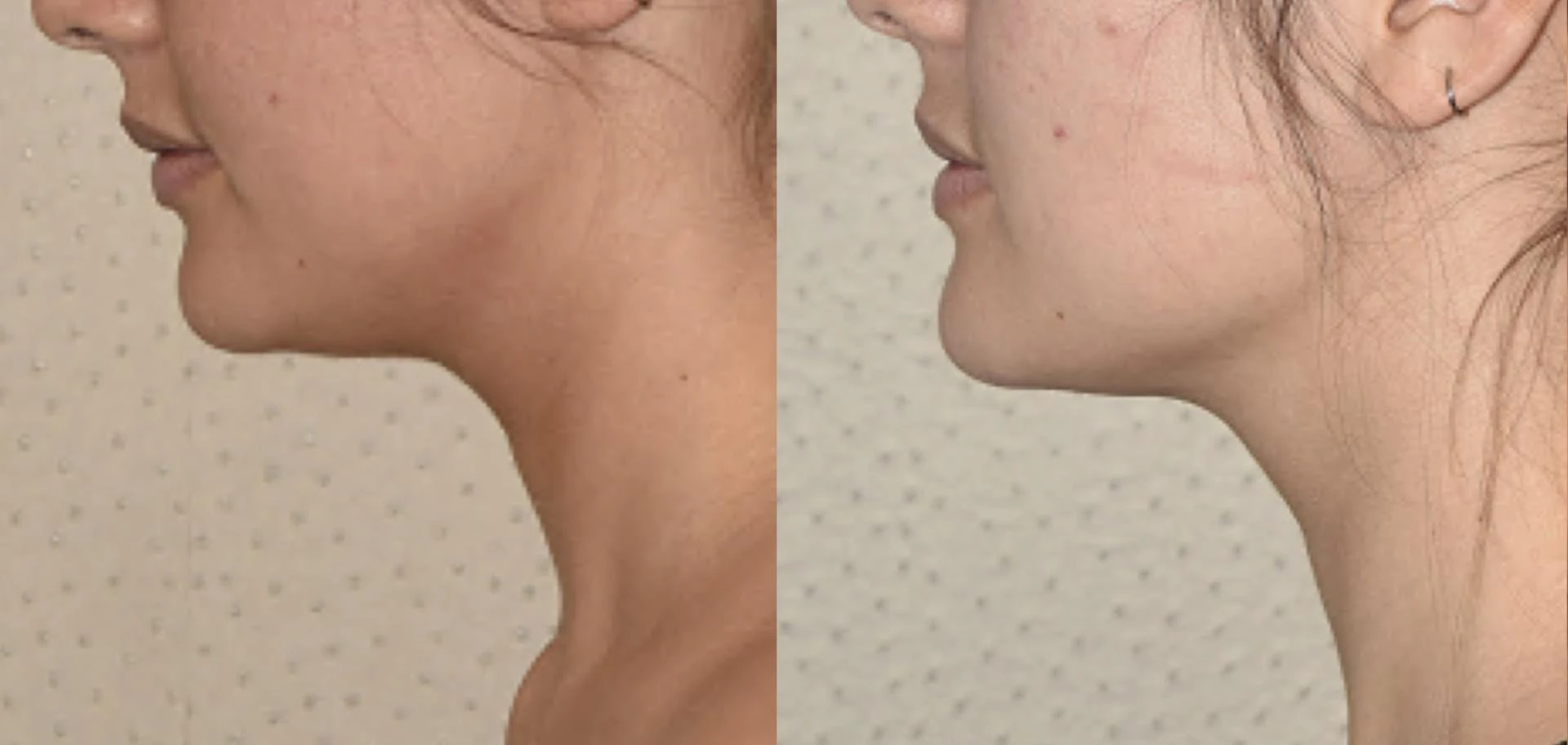 From Double Chin to Defined Contours: The Ultimate Guide to Chin Liposuction in Abu Dhabi