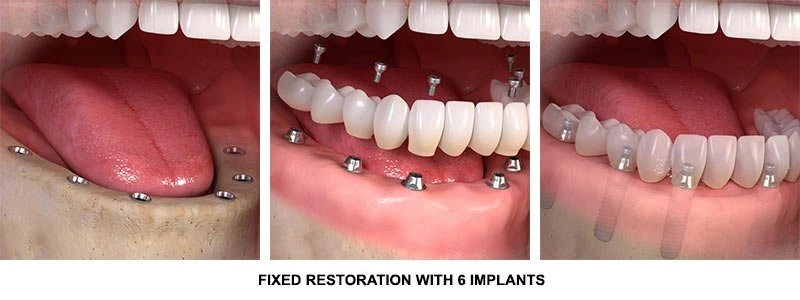 "Regain Confidence And Oral Health: Full Mouth Reconstruction In Stuart, FL"