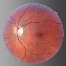 Proliferative Vitreoretinopathy Market Growth | Report, 2023-2033