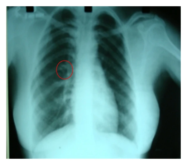 Gorlin Syndrome Market Size, 2023 Analysis, Industry Trends and Forecasts to 2033