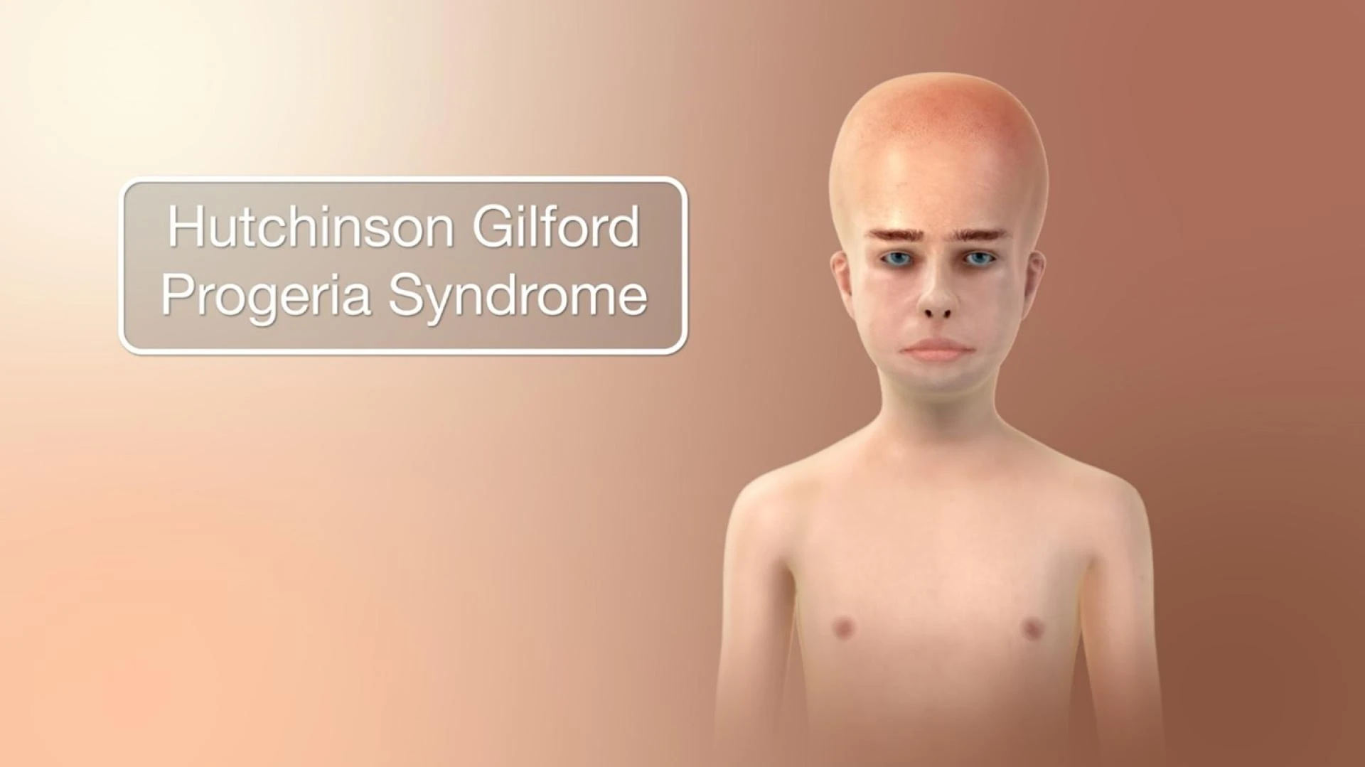 Hutchinson-Gilford Syndrome Market Size, Epidemiology, Analysis &amp; Trends 2023-2033