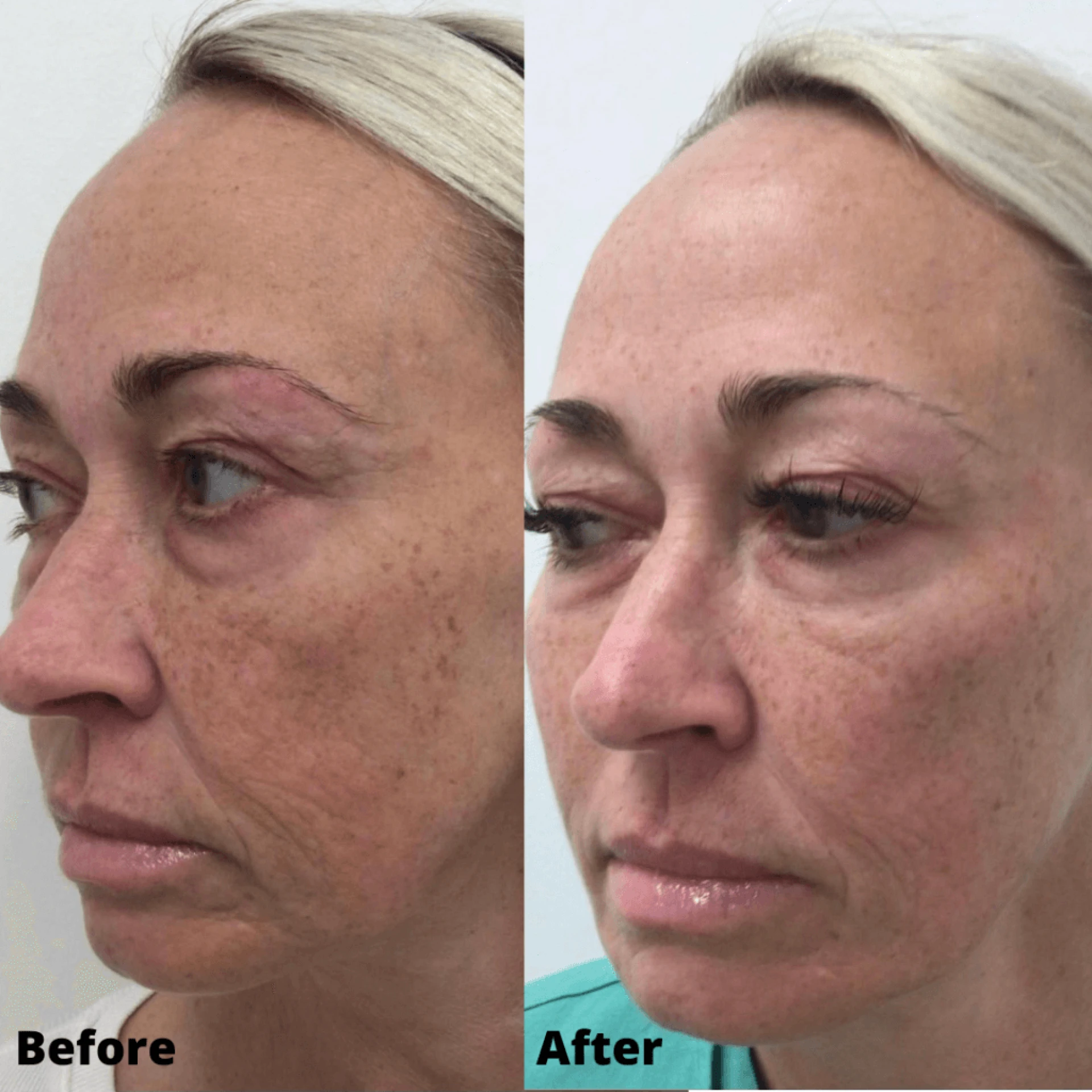 How can losing weight through a perscription of Phentermine help in becoming healthy?