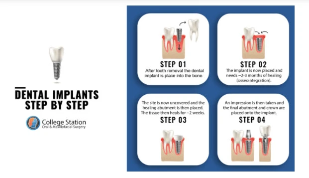 Dental Implant Recovery Process: What You Should Know About It