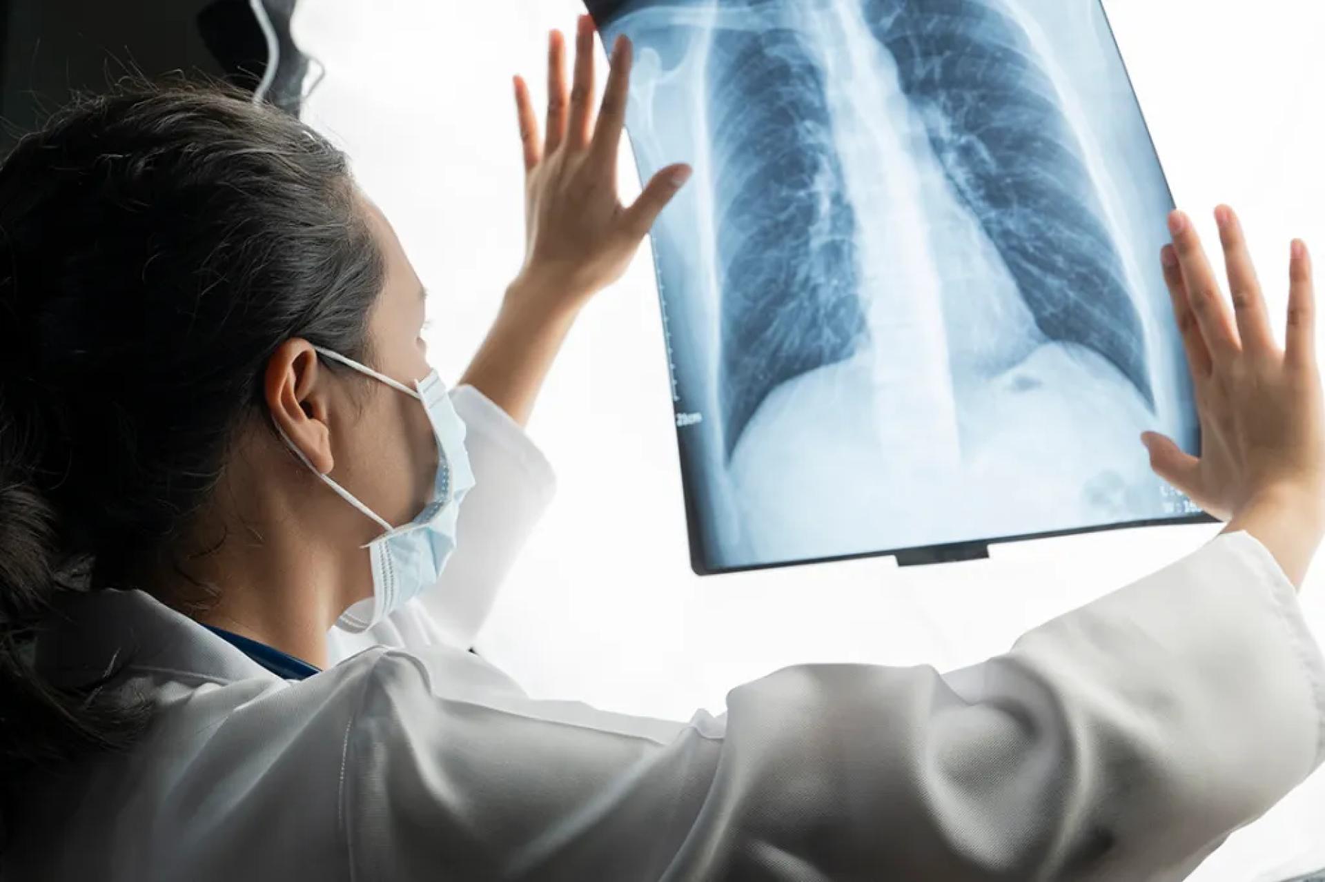 Shedding Light on Treatment Options for Advanced Mesothelioma and Asbestosis
