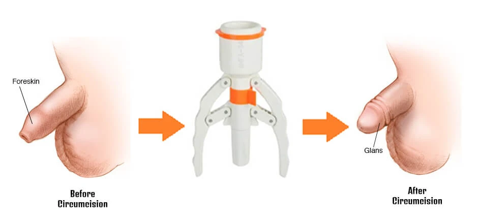 Circumcision in Ahmedabad