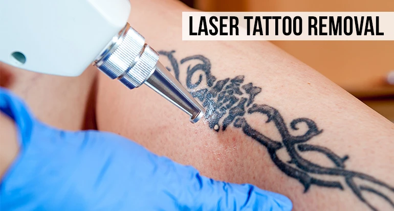 Tattoo Removal Treatment In Hyderabad
