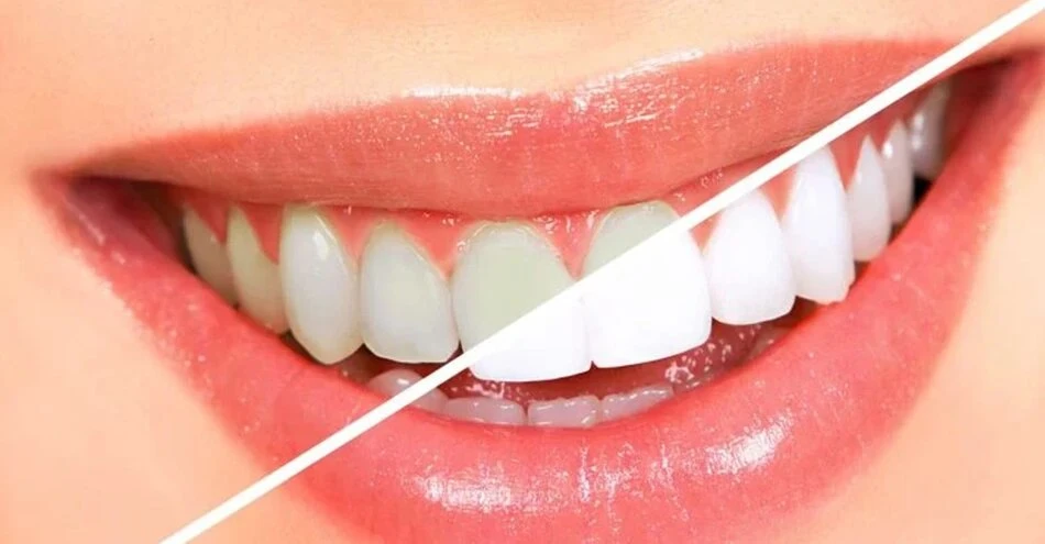 Explanation Of Complete Method Of Teeth Whitening In London Ontario