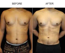 The New Wave in Body Contouring: i-Lipo