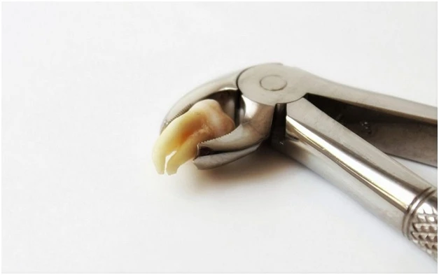 Wisdom Teeth Removal doesn’t have to be Scary!