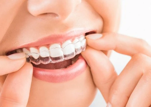 The Invisalign Process: What to Expect During Your Treatment in Orpington