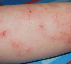 Symptoms, Causes and Treatment of Eczema