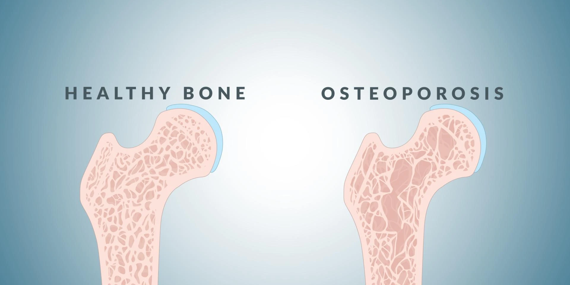 What is it Like to Have Osteoporosis?