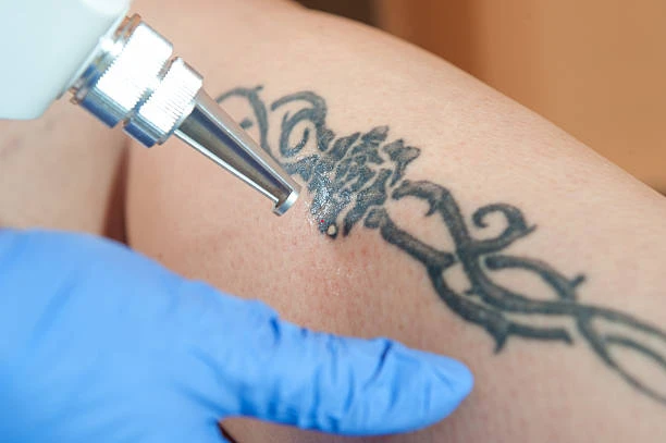 Tattoo removal paper in Riyadh (2)
