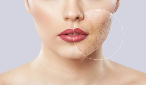 TREATING LARGE PORES (5)